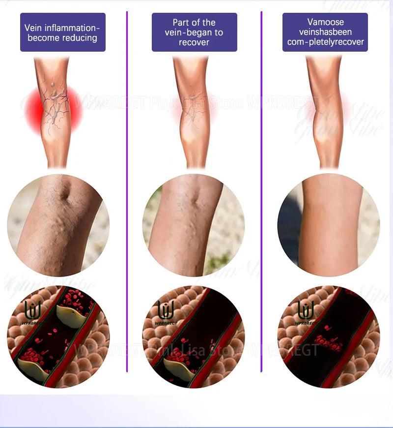 Varicose Vein & Spider Leg Pain Relief Treatment — Painless Care for Vasculitis & Phlebitis