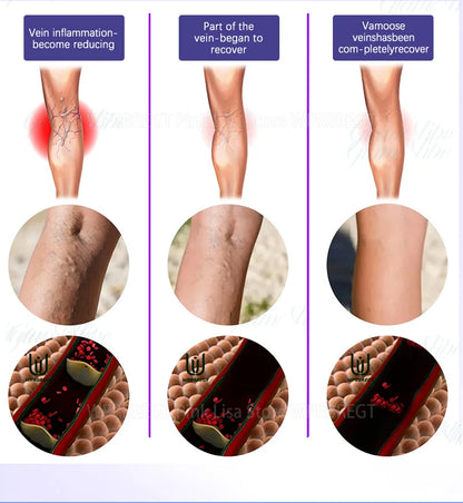 2nd Gen Varicose Vein Laser Therapy Device – Relieves Spider Leg Pain, Treats Vasculitis & Phlebitis