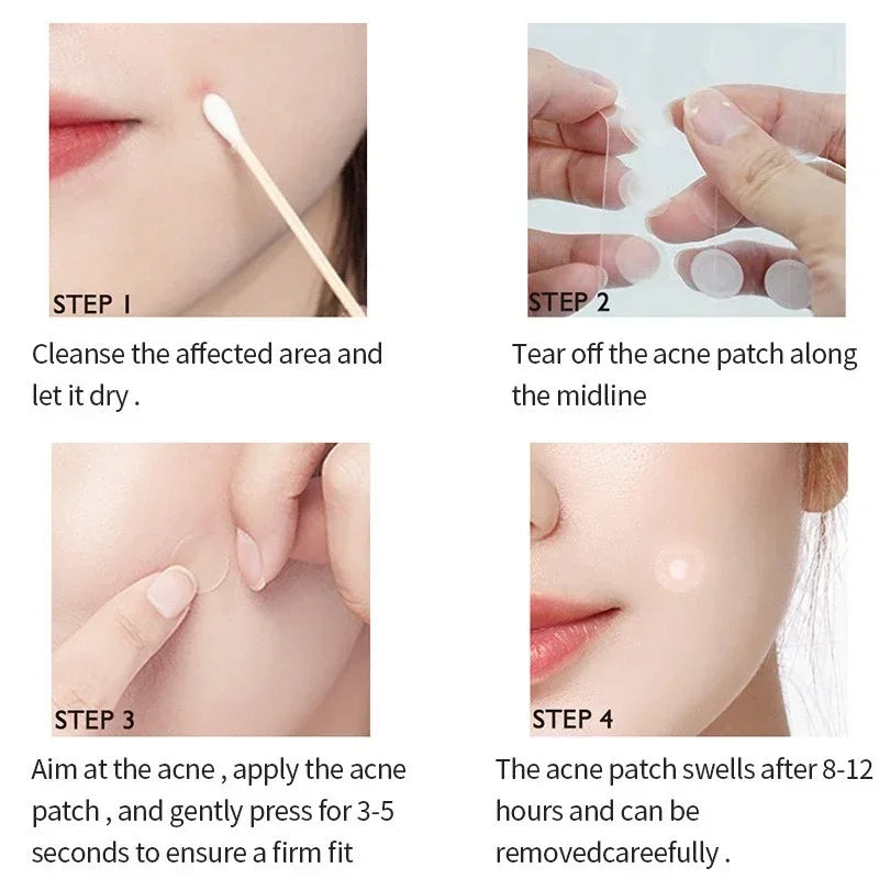 72/180-Piece Hydrocolloid Acne Patches - Waterproof Invisible Pimple Cover Stickers with Printed Designs