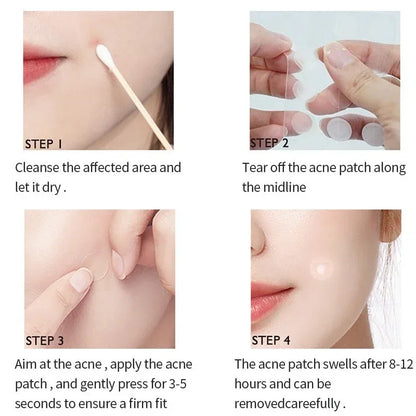 72/180-Piece Hydrocolloid Acne Patches - Waterproof Invisible Pimple Cover Stickers with Printed Designs