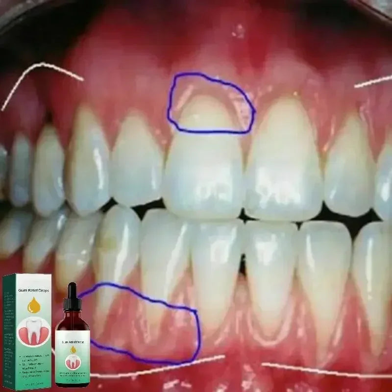 30ml Gingival Repair Drops – Fast Treatment for Cavities, Receding Gums & Gum Pain Relief