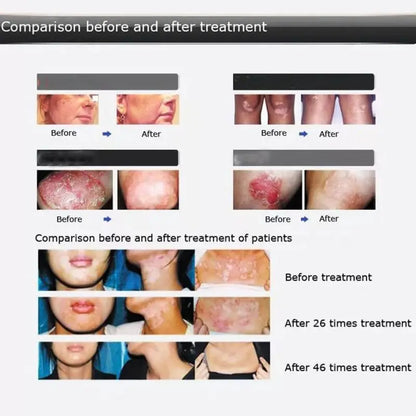 UV 311nm Phototherapy Device – Philips UVB Lamp for Vitiligo, Psoriasis & Skin Treatment