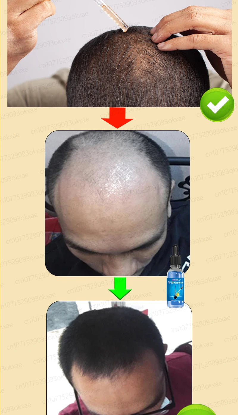 WPRBREGT Blue Hair Growth Serum — Essential Oil for Thicker Hair, Anti-Baldness Treatment