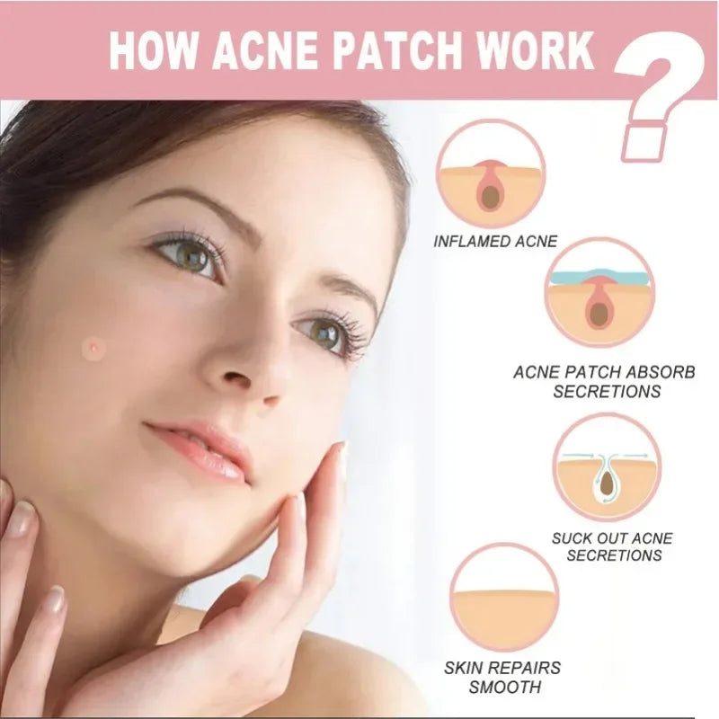 72/180-Piece Hydrocolloid Acne Patches - Waterproof Invisible Pimple Cover Stickers with Printed Designs