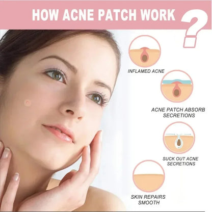 72/180-Piece Hydrocolloid Acne Patches - Waterproof Invisible Pimple Cover Stickers with Printed Designs