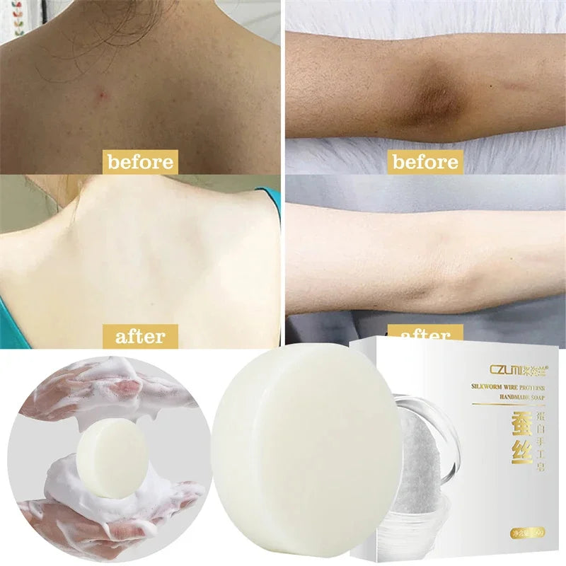 Body Whitening Soap – Underarm & Knee Bleaching, Dark Spot Removal, Chicken Skin Treatment, Dead Skin Exfoliating & Moisturizing