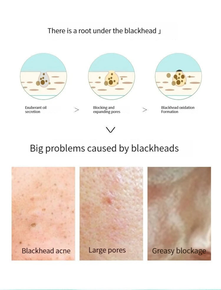 5PCS Blackhead Removal Nasal Strips – Acne & Pore Shrinking, Deep Cleaning Magic Adsorption for Smooth Skin