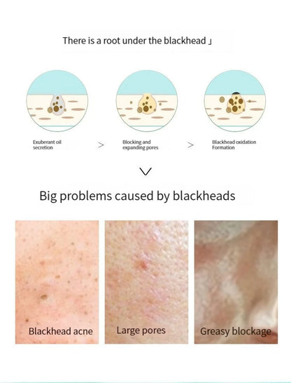 5PCS Blackhead Removal Nasal Strips – Acne & Pore Shrinking, Deep Cleaning Magic Adsorption for Smooth Skin