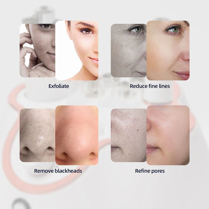 Professional Diamond Microdermabrasion Machine – At-Home Facial Peeling & Deep Cleaning Skin Care Tool