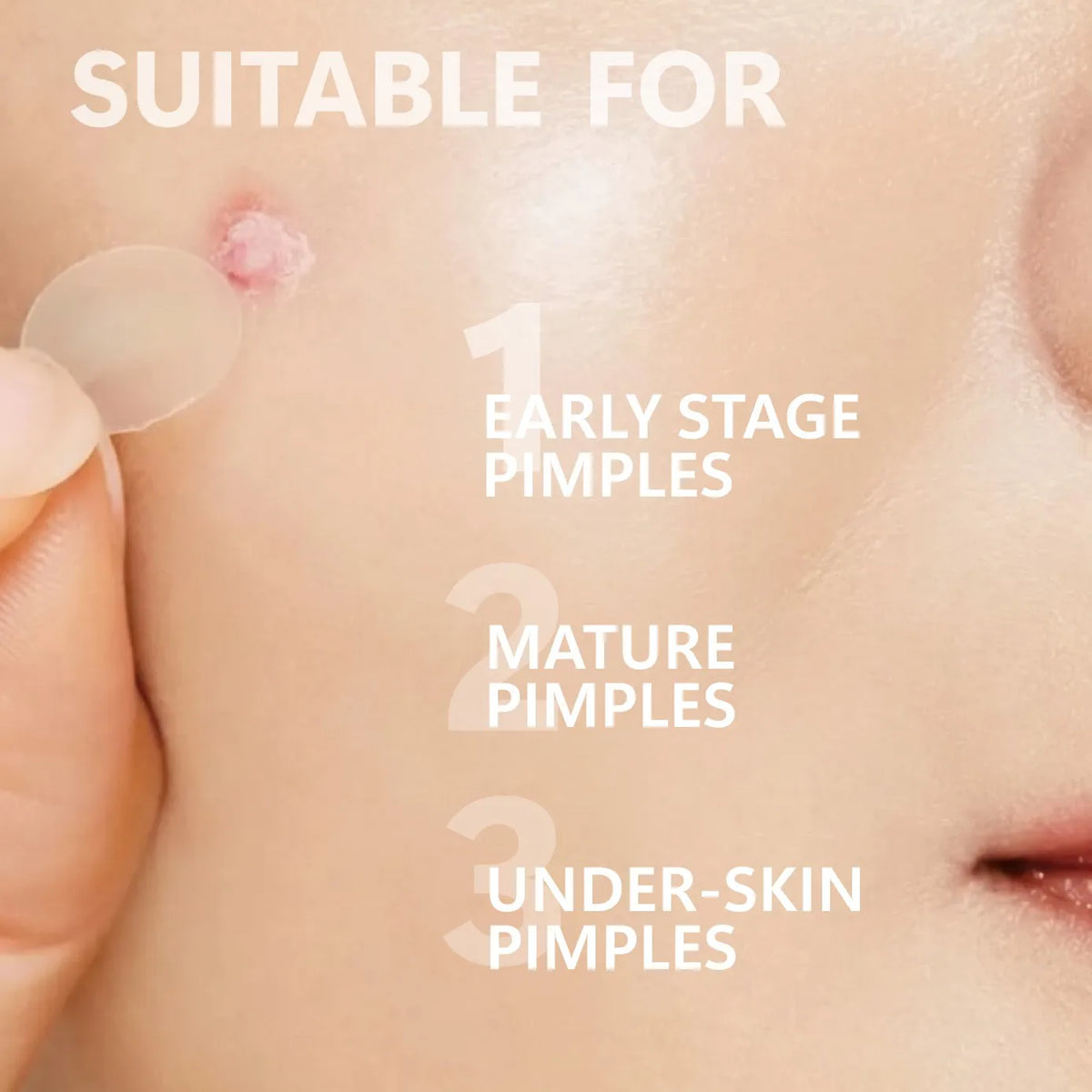 Microneedle Pimple Patches - 24-Pack Hydrocolloid Microdart Acne & Blemish Treatment Patches