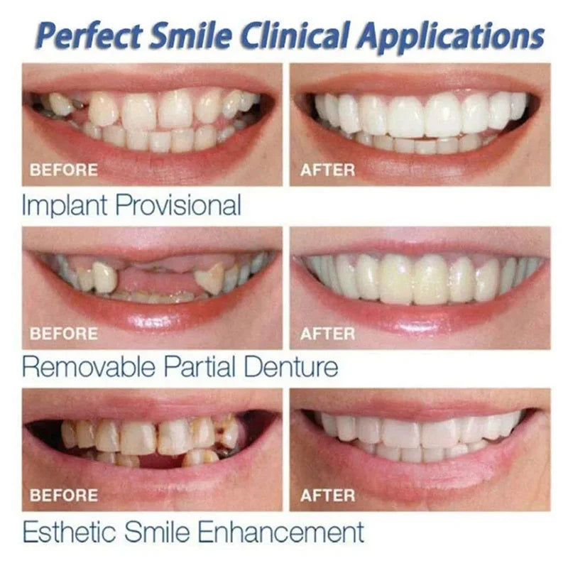 White Fake Teeth Cover – Whitening & Interdental Gap Decor, Portable Braces for Aesthetic Dental Beauty