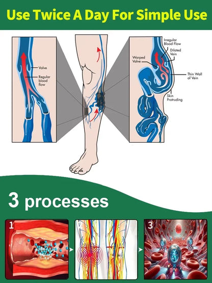 Medical-Grade Laser Treatment for Varicose & Spider Veins – Painless Leg Vein Therapy Equipment
