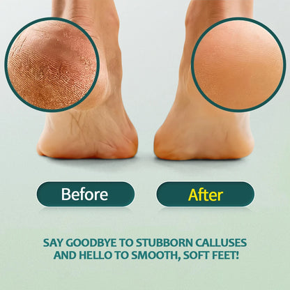 NAILPOP Extra Strength Callus Remover & Foot File Kit - Fast Hard Skin, Heel & Tough Callus Removal
