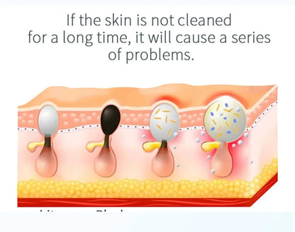 New Peeling Beauty Device – Small Bubble Oxygen Injection Hydra Dermabrasion Aqua Facial Cleaner for Blackhead Removal