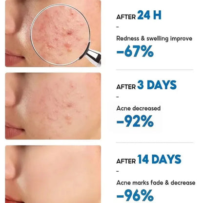 Effective Acne Removal Cream 30g – Anti-Acne Gel for Redness, Pimples, Deep Pore Cleaning & Oil Control Skin Care