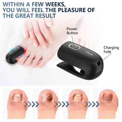 Fast Nail Fungus Repair with Fungal Nail Laser Device - Effective Onychomycosis Treatment