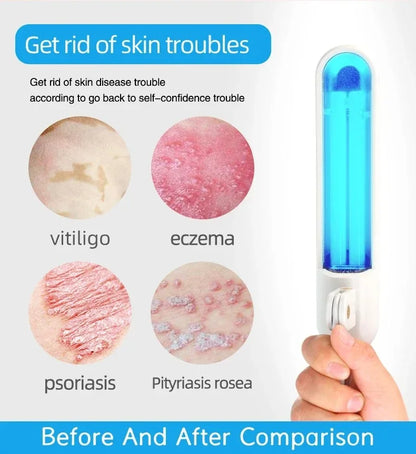 311nm UVB Phototherapy Lamp – Narrow Band UV Light Therapy Device for Vitiligo & Psoriasis Skin Treatment Instrument
