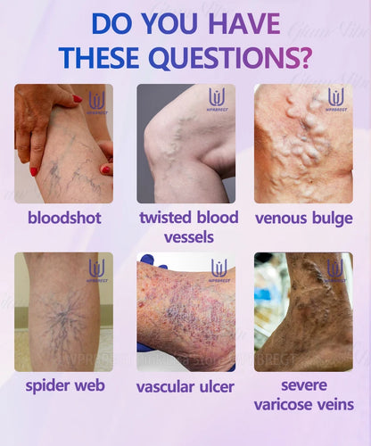 2nd Gen Varicose Vein Laser Therapy Device – Relieves Spider Leg Pain, Treats Vasculitis & Phlebitis