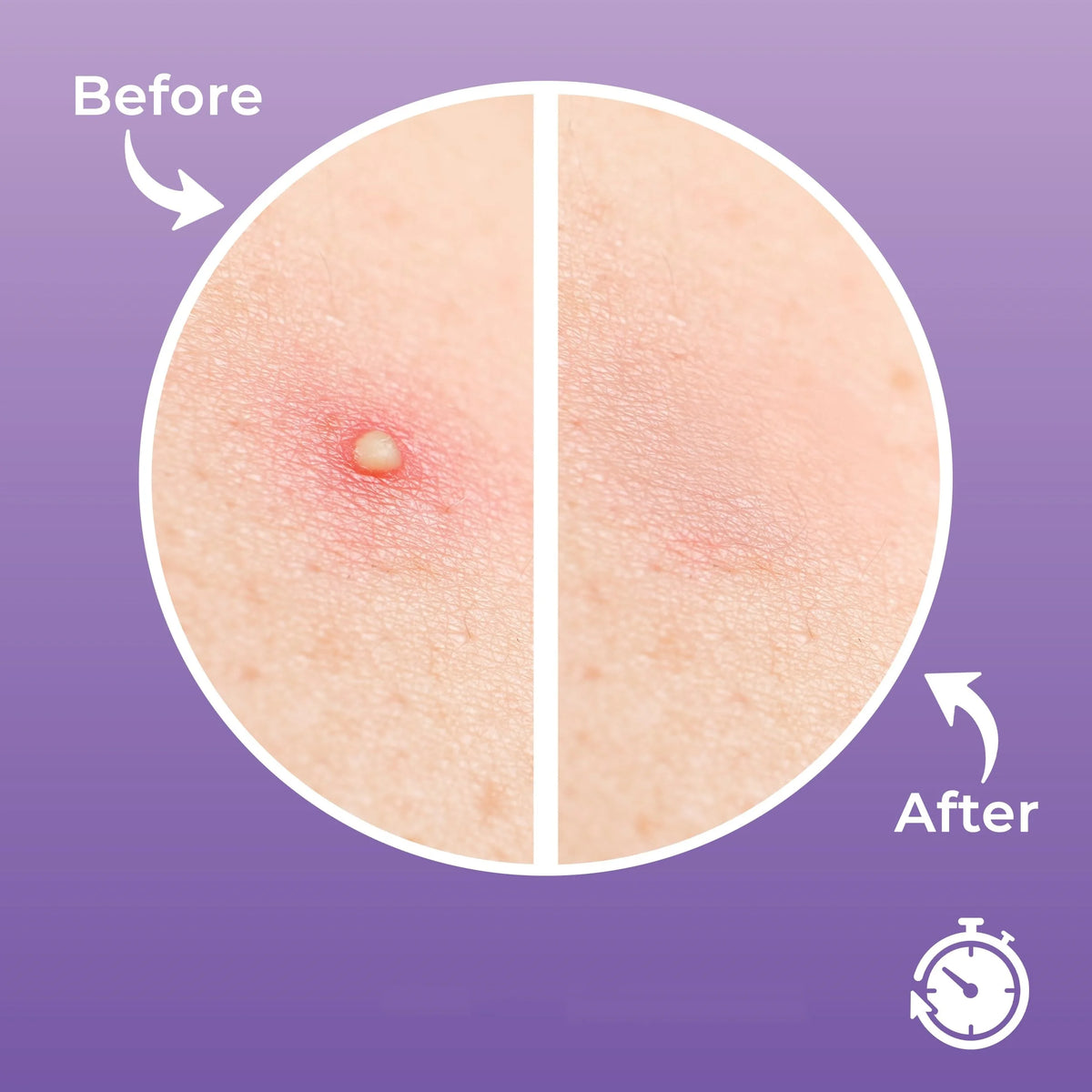 30 XL Acne Patches - Waterproof Invisible Pimple Patches for Day and Night Skincare
