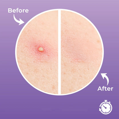 30 XL Acne Patches - Waterproof Invisible Pimple Patches for Day and Night Skincare