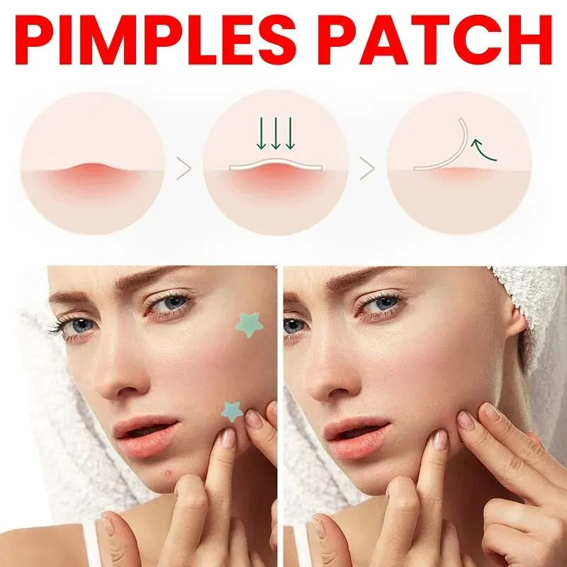 Acne Patch for Facial Skin Care - Fade Blemishes & Pimple Marks - Cover & Repair Acne Blemishes