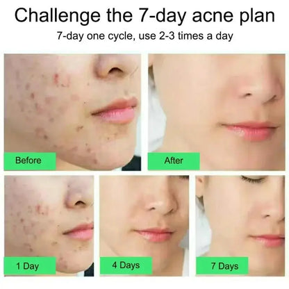 Salicylic Acid Acne Removal Cream – Anti-Acne, Redness Repair, Deep Cleaning & Oil Control Skincare
