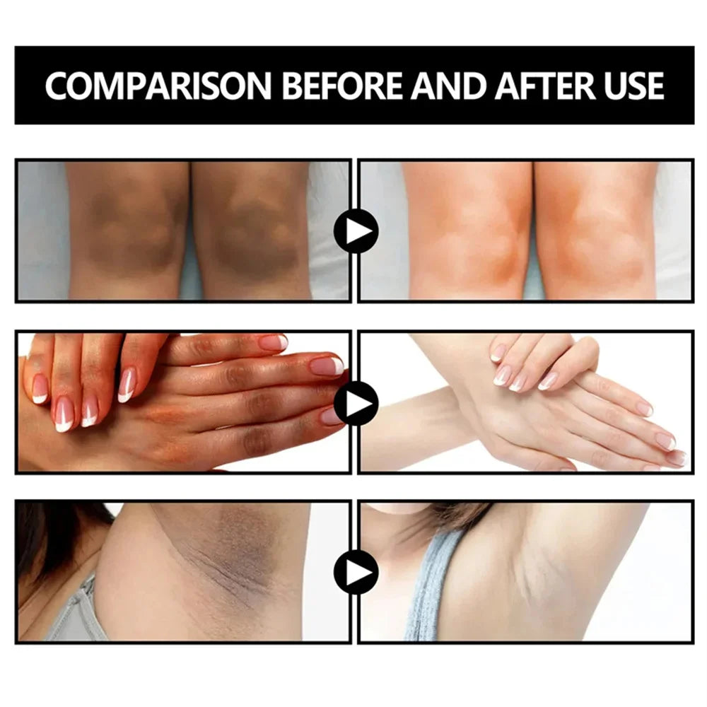Body Whitening Soap – Underarm & Knee Bleaching, Dark Spot Removal, Chicken Skin Treatment, Dead Skin Exfoliating & Moisturizing