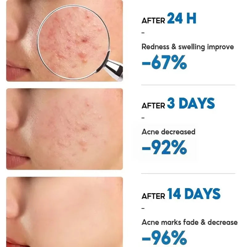 Effective Acne Removal Cream – Anti-Acne Gel for Redness, Pimples, Deep Pore Cleaning & Oil Control Skin Care
