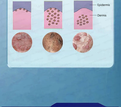 Safe Skin-Friendly Wart Removal Methods – Gentle Solutions for Effective Wart Treatment