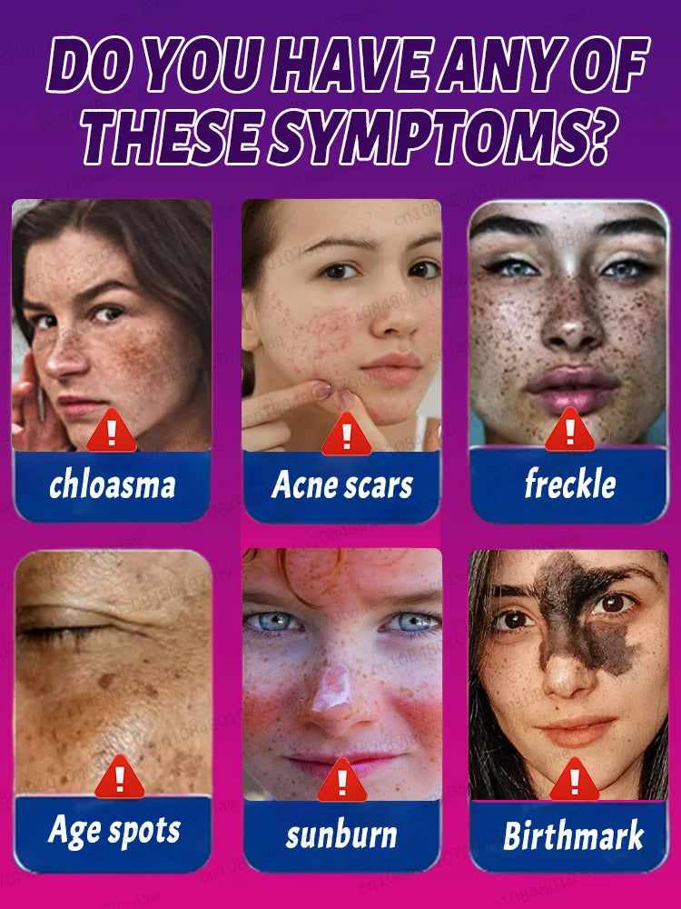 Freckle & Dark Spot Removal Treatment – Fade Chloasma, Age Spots, Acne Marks & Sun Spots