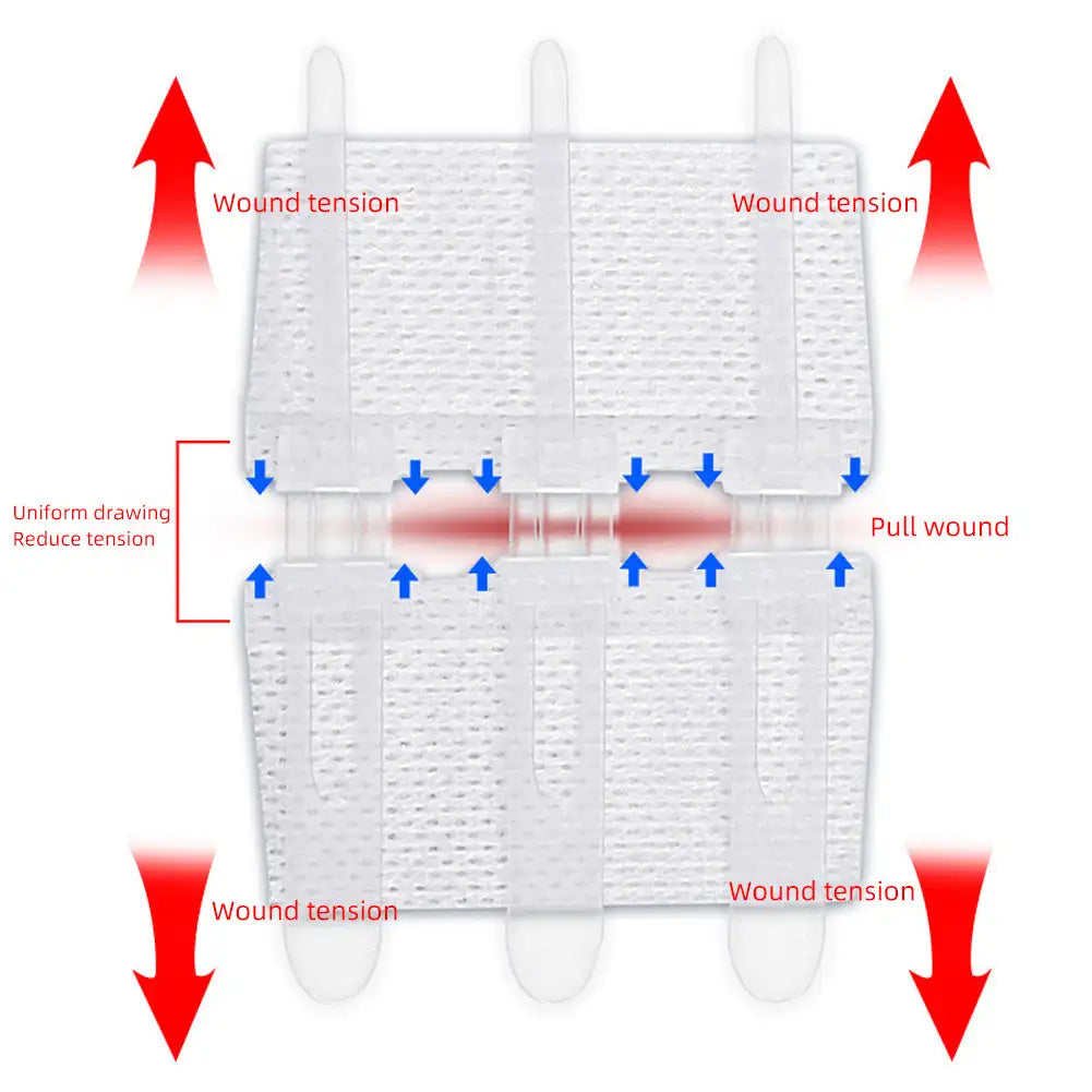 Emergency Wound Closure Strips - Zipper-Style Suture-Free Laceration Closure Device for First Aid