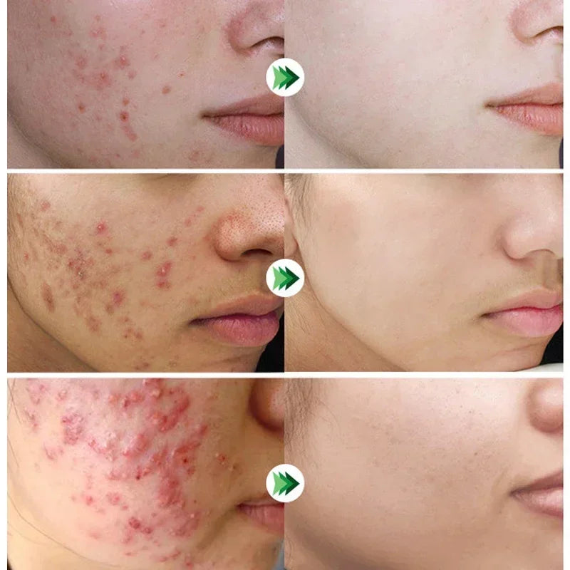 Salicylic Acid Acne Removal Cream – Anti-Acne, Redness Repair, Deep Cleaning & Oil Control Skincare