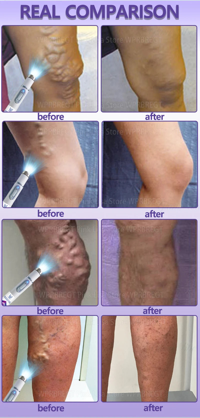 2nd Gen Varicose Vein Laser Therapy Device – Relieves Spider Leg Pain, Treats Vasculitis & Phlebitis