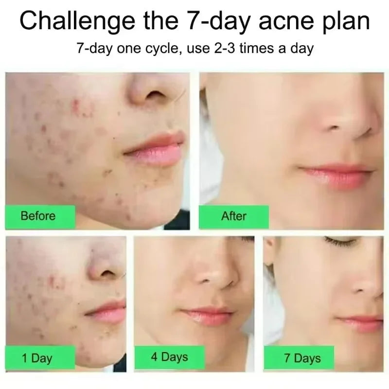 Effective Acne Removal Cream – Anti-Acne Gel for Redness, Pimples, Deep Pore Cleaning & Oil Control Skin Care