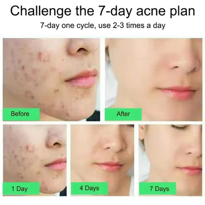 Effective Acne Removal Cream – Anti-Acne Gel for Redness, Pimples, Deep Pore Cleaning & Oil Control Skin Care