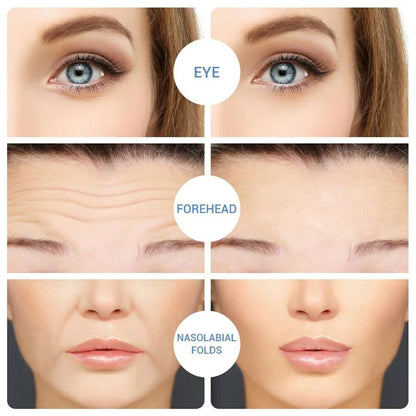 Micro-Needle Hyaluronic Acid Eye Patch – Anti-Wrinkle Moisturizing Eye Mask for Fine Lines Removal