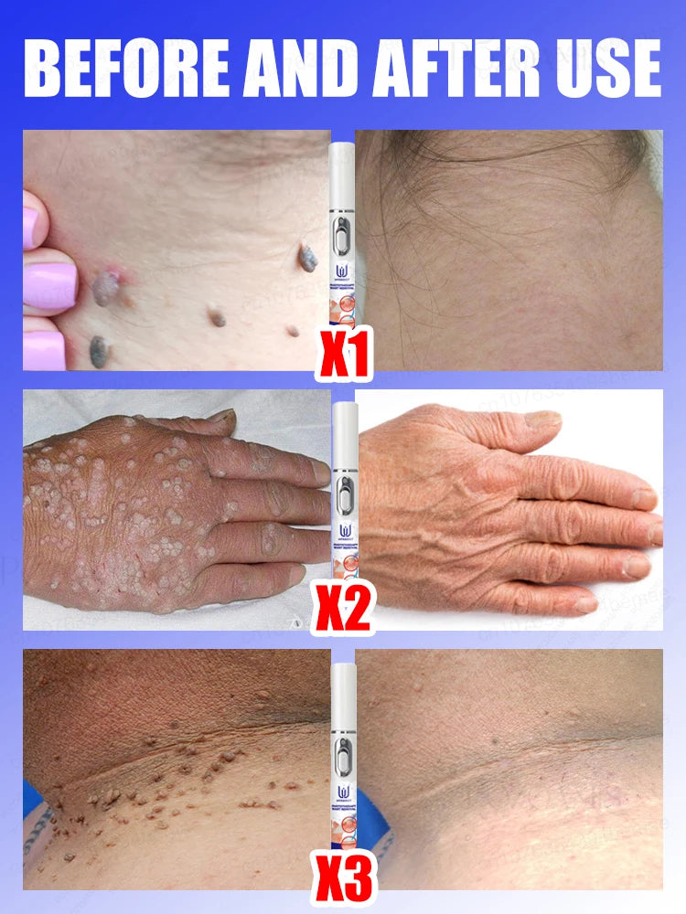 Quick Wart & Sarcoma Removal Treatment – Fast & Effective Skin Care Solution