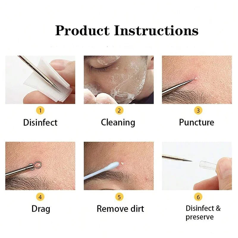 4/6PCS Face Cleaning Kit – Pimple, Blackhead & Whitehead Remover Tools for Acne and Comedone Care