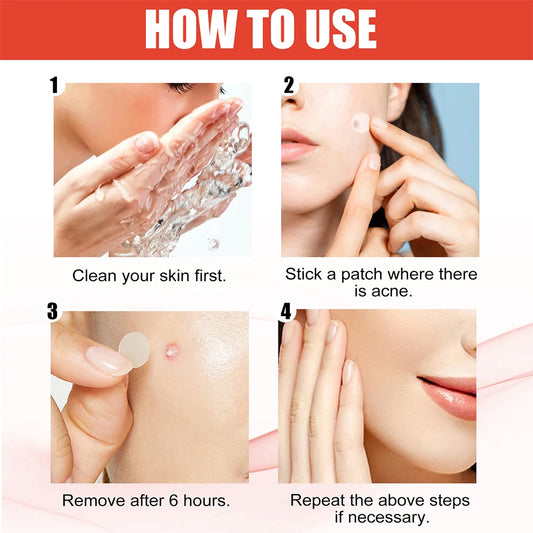 144PCS Acne Pimple Patch Set – Invisible Hydrocolloid Spot Stickers for Face Care & Healing (Men & Women)