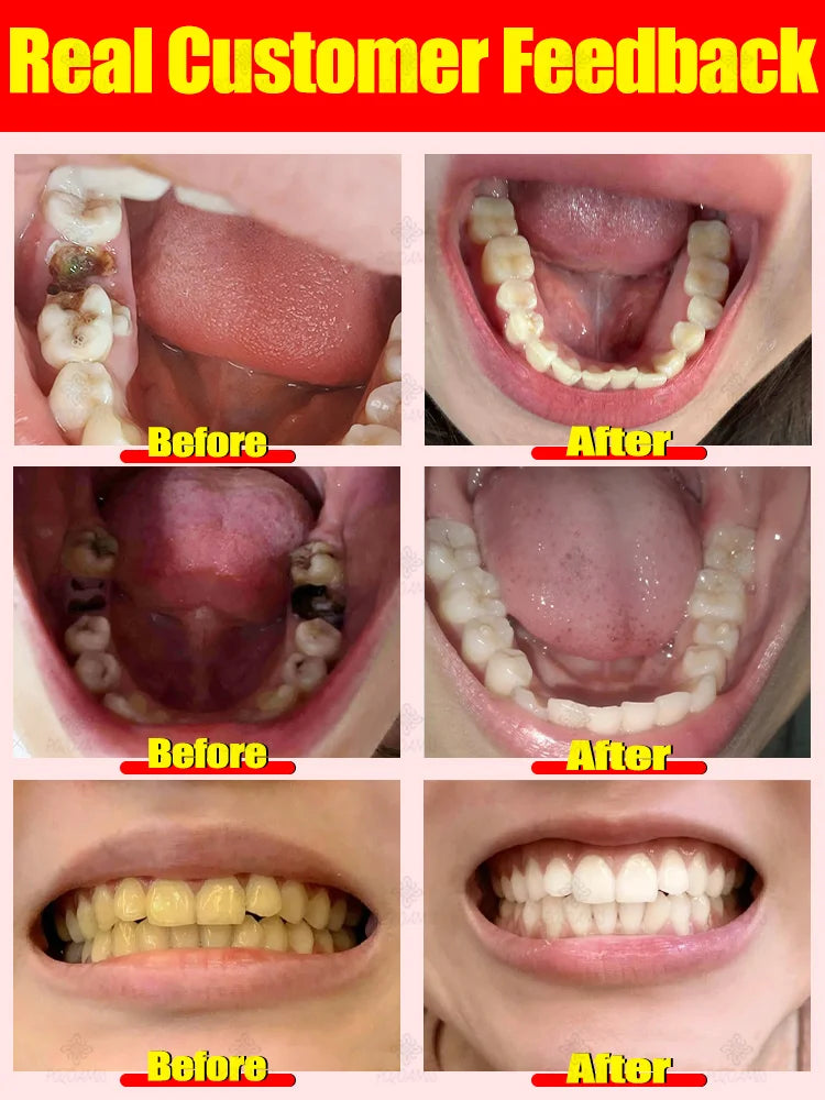 Rapid Cavity Repair Toothpaste – Effective Tooth Decay Treatment