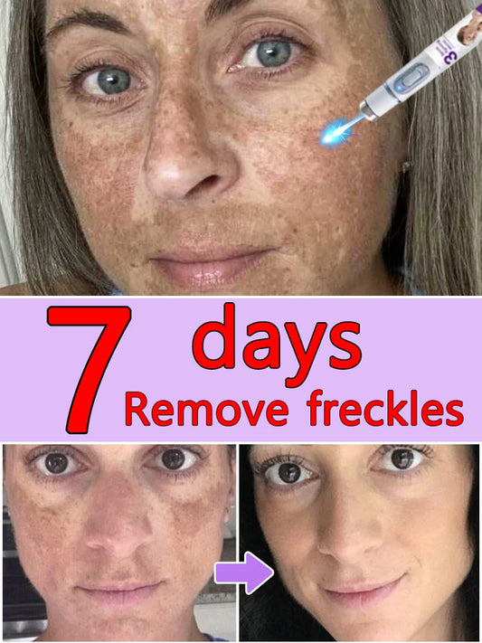 Freckle & Dark Spot Removal Treatment – Fade Chloasma, Age Spots, Acne Marks & Sun Spots