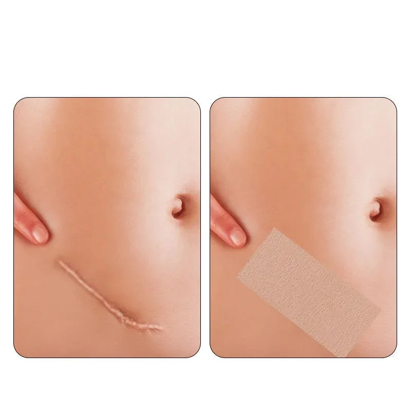 Invisible Skin-Tone Tattoo Cover Patches - Natural-Looking Birthmark Concealer for Arms, Legs, Back, and Post-Surgery Coverage