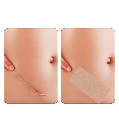 Invisible Skin-Tone Tattoo Cover Patches - Natural-Looking Birthmark Concealer for Arms, Legs, Back, and Post-Surgery Coverage