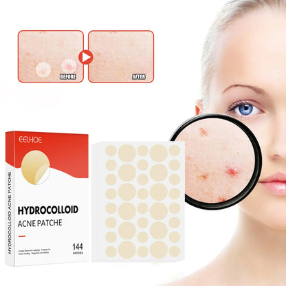 144PCS Acne Pimple Patch Set – Invisible Hydrocolloid Spot Stickers for Face Care & Healing (Men & Women)