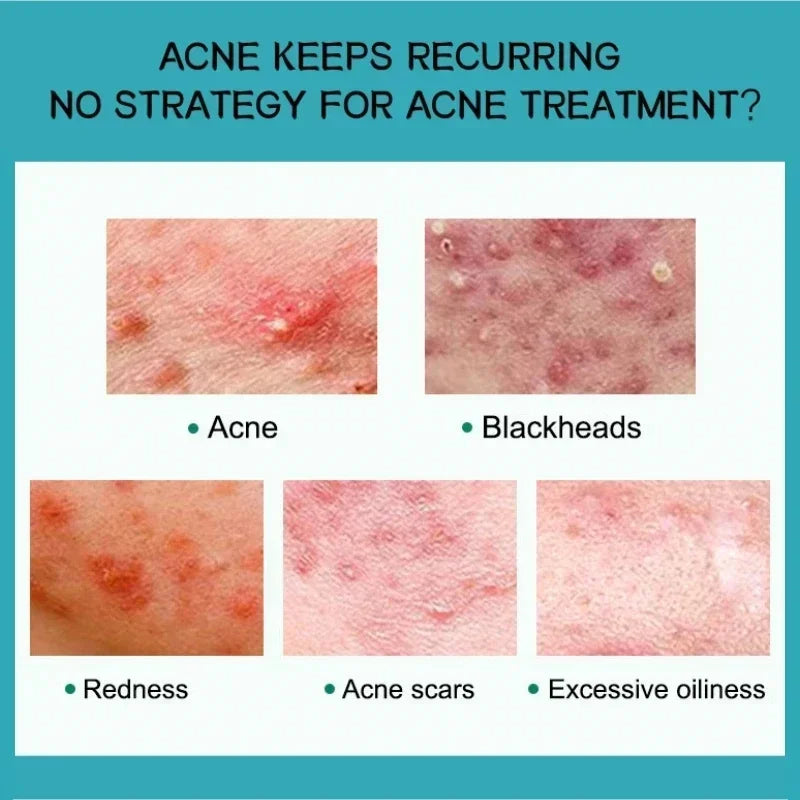 Effective Acne Removal Cream 30g – Anti-Acne Gel for Redness, Pimples, Deep Pore Cleaning & Oil Control Skin Care