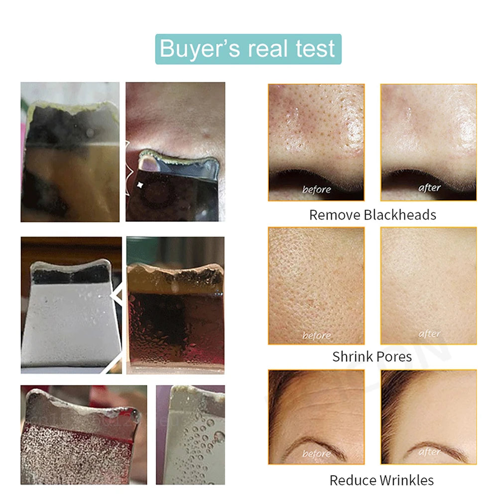 Ultrasonic Skin Scrubber: Blackhead Remover & Deep Face Cleaning Ion Acne Pore Cleaner - Facial Shovel Cleanser