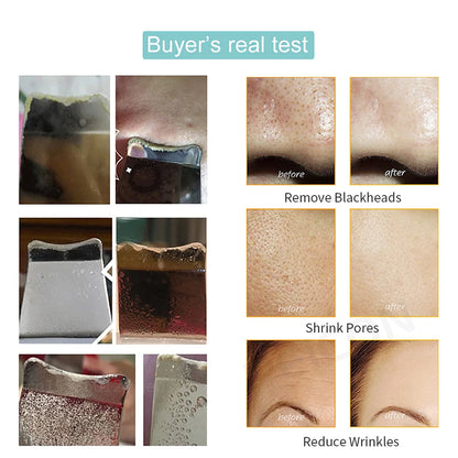 Ultrasonic Skin Scrubber: Blackhead Remover & Deep Face Cleaning Ion Acne Pore Cleaner - Facial Shovel Cleanser