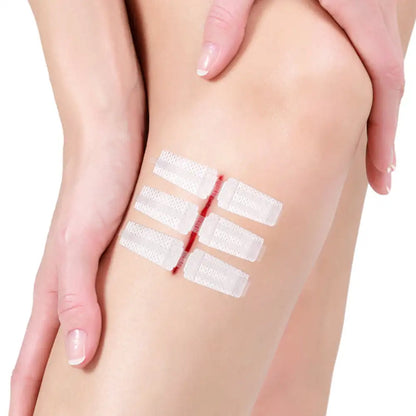 Emergency Wound Closure Strips - Zipper-Style Suture-Free Laceration Closure Device for First Aid