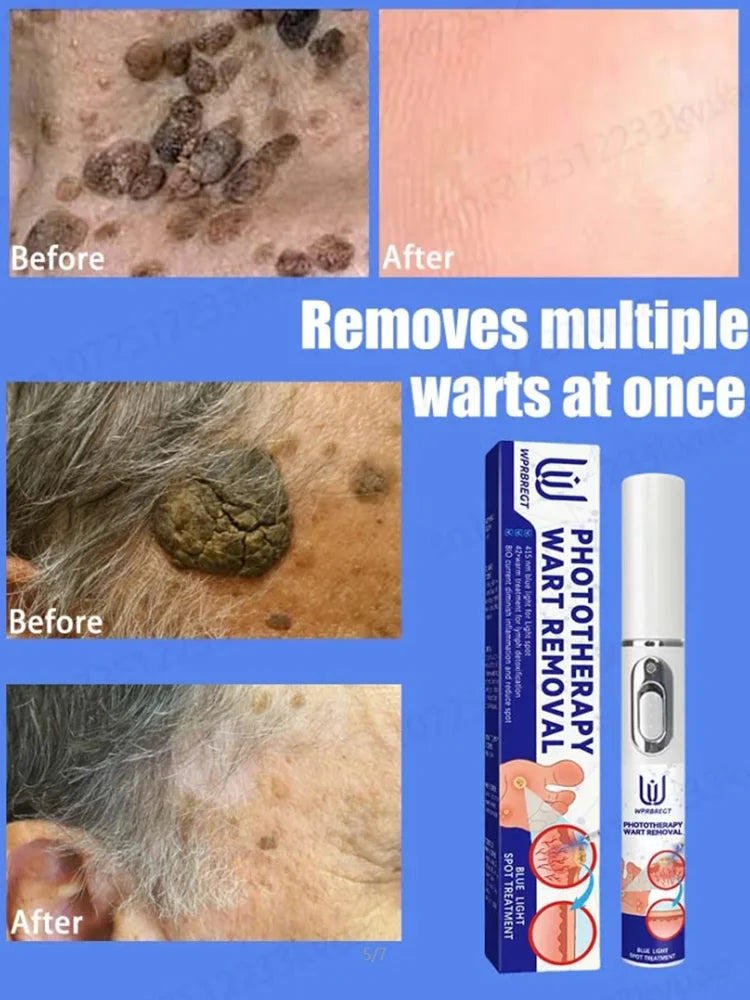 Safe Skin-Friendly Wart Removal Methods – Gentle Solutions for Effective Wart Treatment