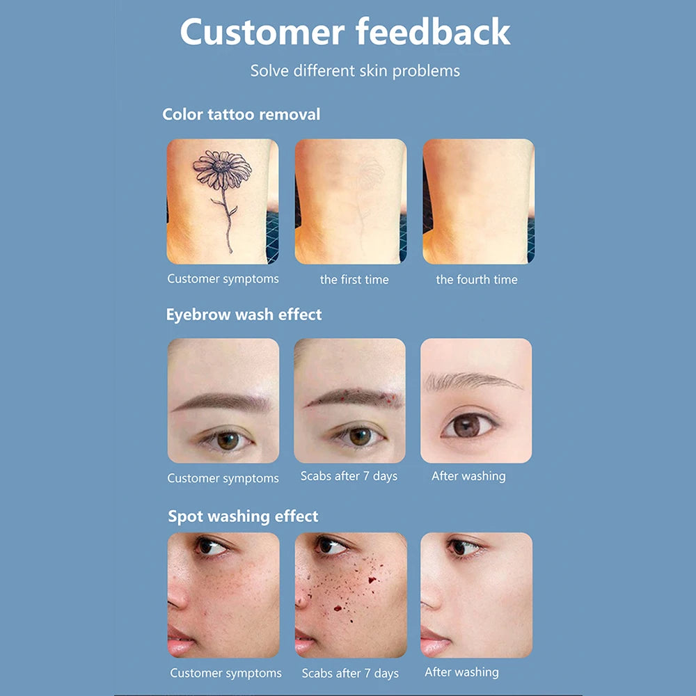 Q-Switch ND YAG Laser Machine – Tattoo & Eyebrow Removal, Mole & Freckle Whitening (532nm 755nm 1064nm)